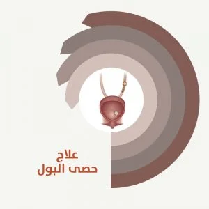 علاج حصى البول