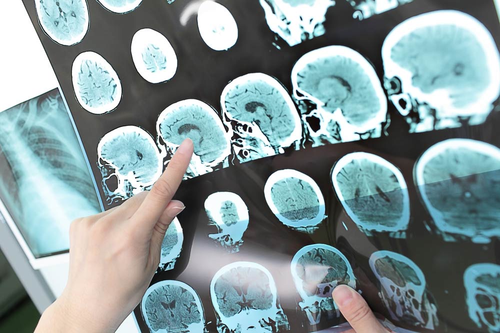 كيف يؤثر التصلب اللويحي - التصلب المتعدد على الدماغ؟ وما هو علاجه؟