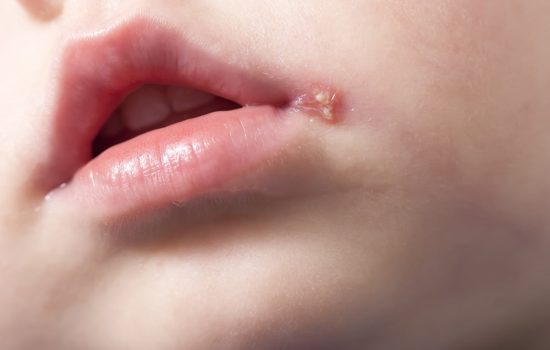 الهربس الفموي عند الأطفال: أسبابه أعراضه وطرق التخلص منه