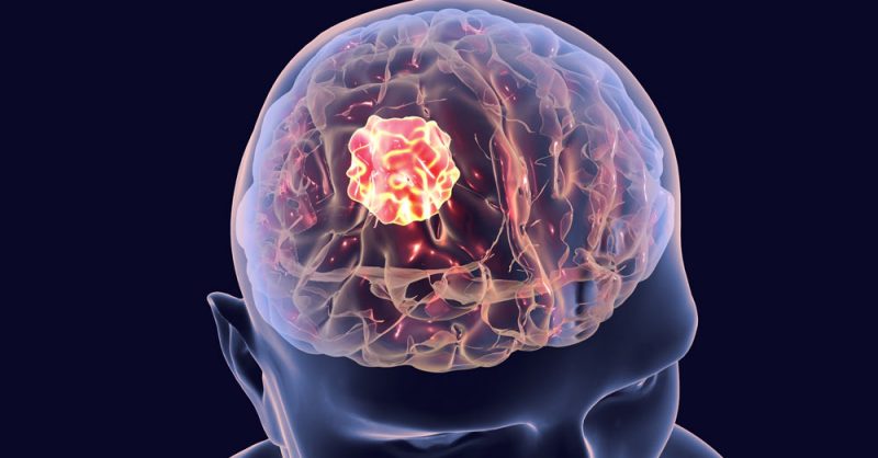 سرطان الدماغ ، ماهي أعراضه،أسبابه وطرق العلاج؟