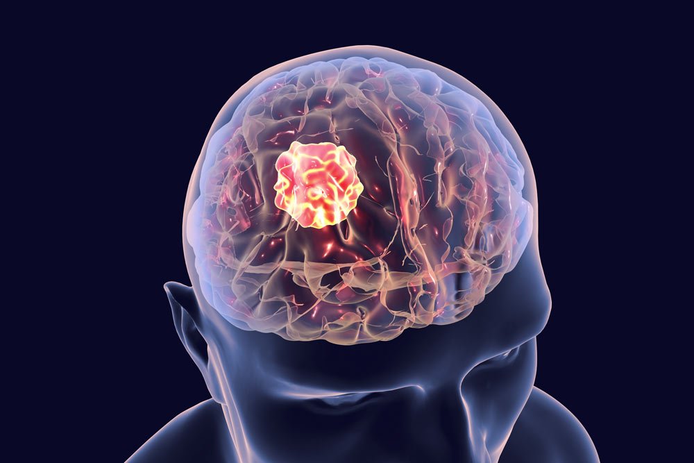 سرطان الدماغ ، ماهي أعراضه،أسبابه وطرق العلاج؟