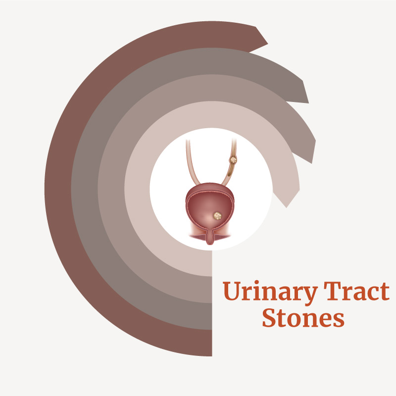Treatment for Urinary Tract Stones