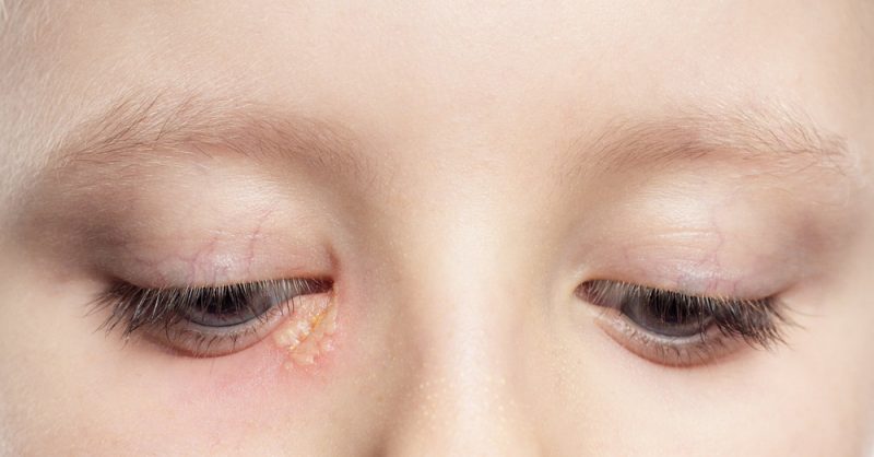 Eye Herpes