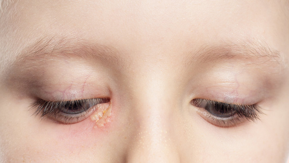 Eye Herpes: All You Need to Know - Hekma Center