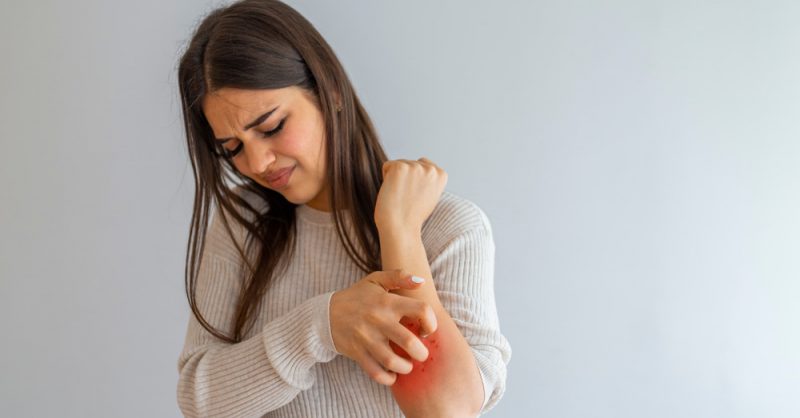 Itching in Multiple Sclerosis