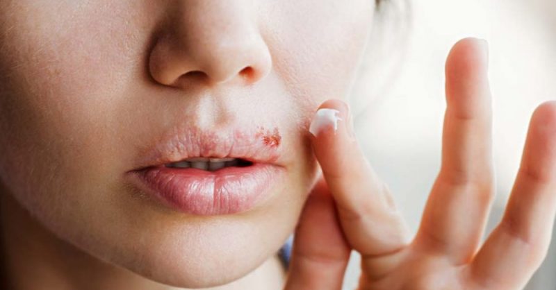 what is herpes simplex virus